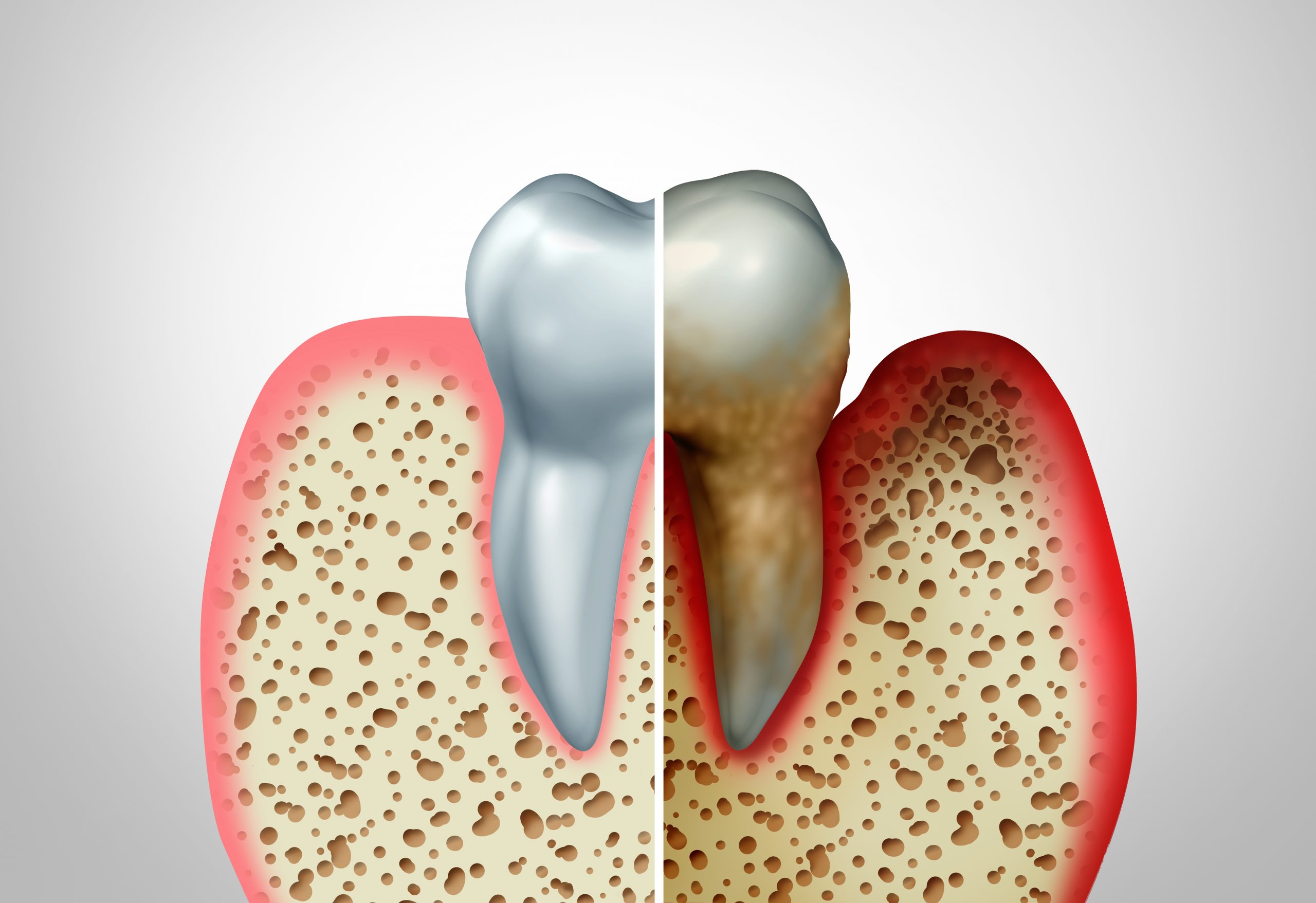 Periodontics Scaled