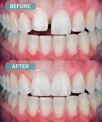 Porcelain Veneers