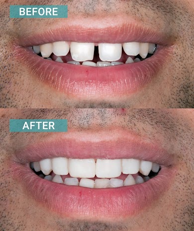 Porcelain Veneers Result